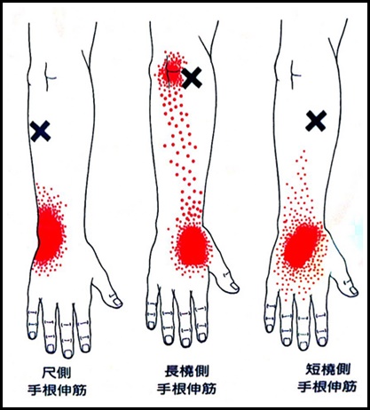 手根伸筋