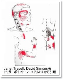 トリガーポイントと関連痛